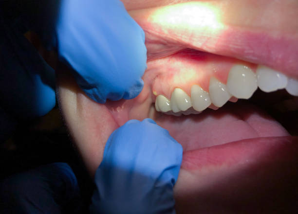 Best Emergency Dental Extractions in New Baden, IL