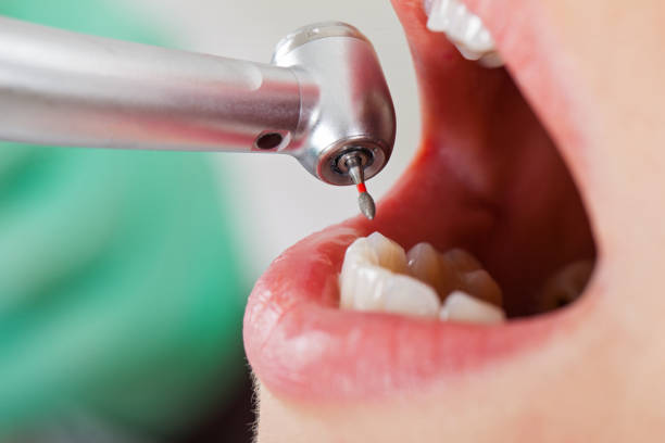 Best Emergency Dentist for Lost Fillings or Crowns in New Baden, IL